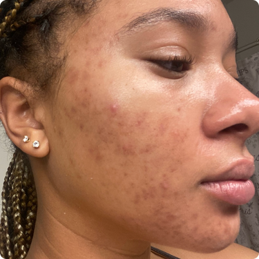 fade hyperpigmentation
